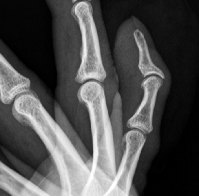 유리 파편 제거 후 손가락 X-ray 사진