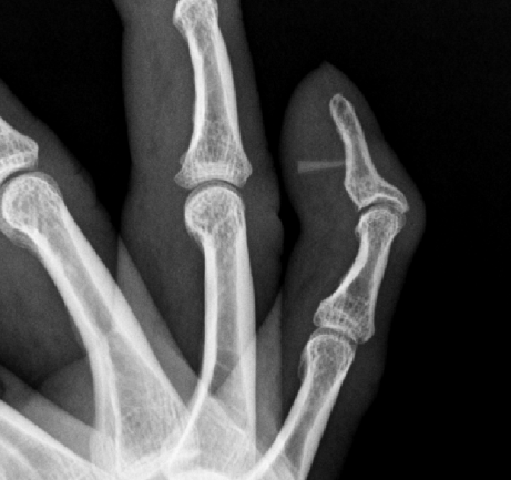 손가락 안에 남은 유리 파편 수술 전 X-ray 사진