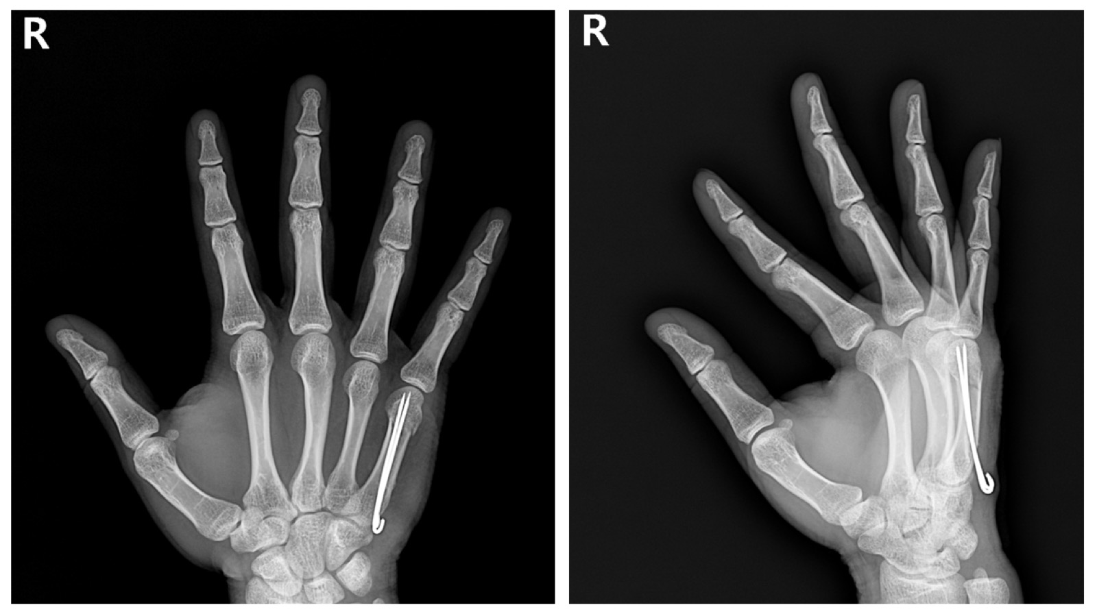 복서 골절 수술 후 X-ray 사진