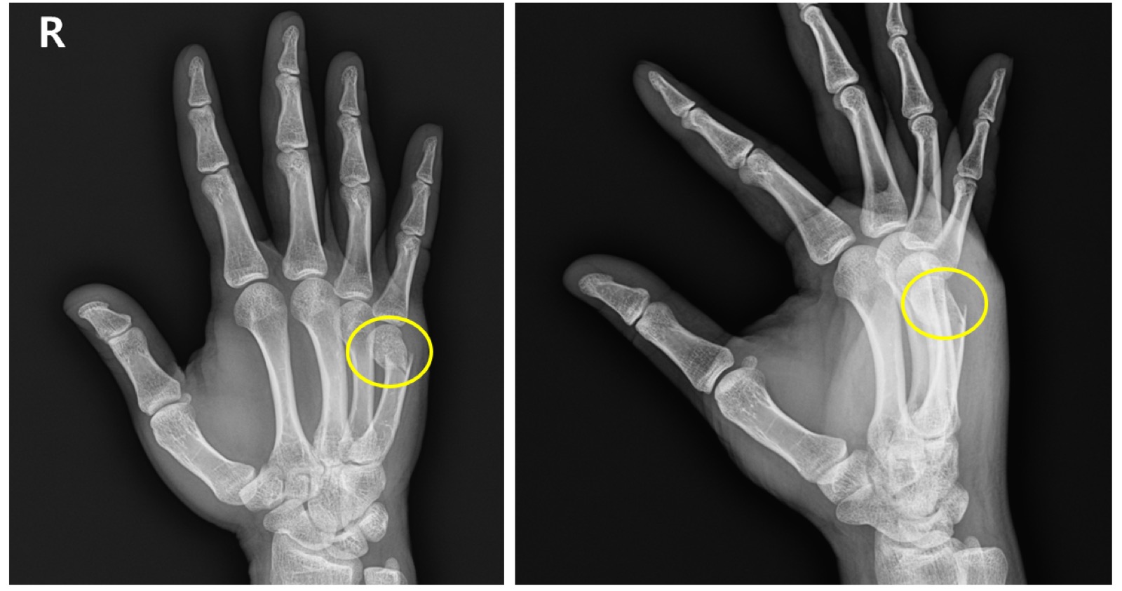 복서 골절 수술 전 X-ray 사진