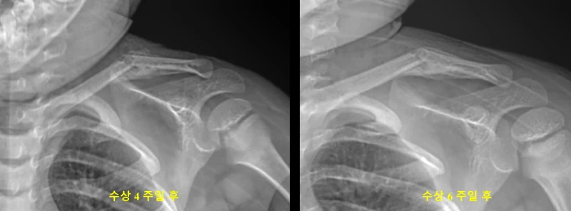 소아 쇄골 골절 회복 경과 X-ray 블로그 사례 사진