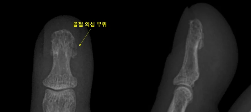 손끝 골절 X-ray 블로그 사례 사진