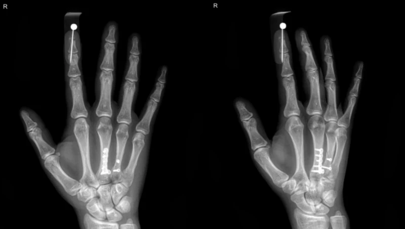 손가락 끝과 중수골 골절 수술 후 X-ray 블로그 사례 사진