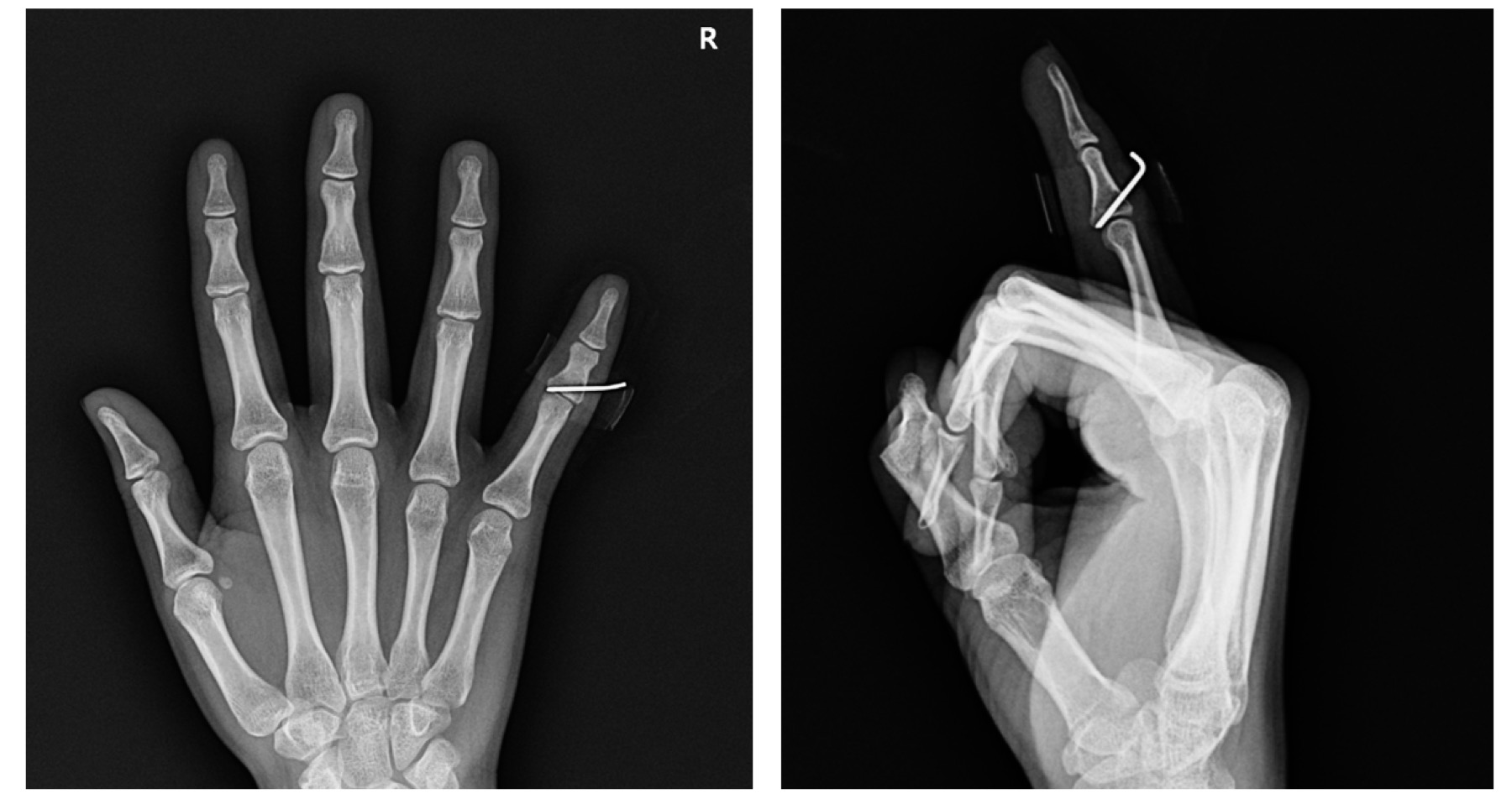 새끼손가락 중위지관절 골절 수술 후 X-ray 사진