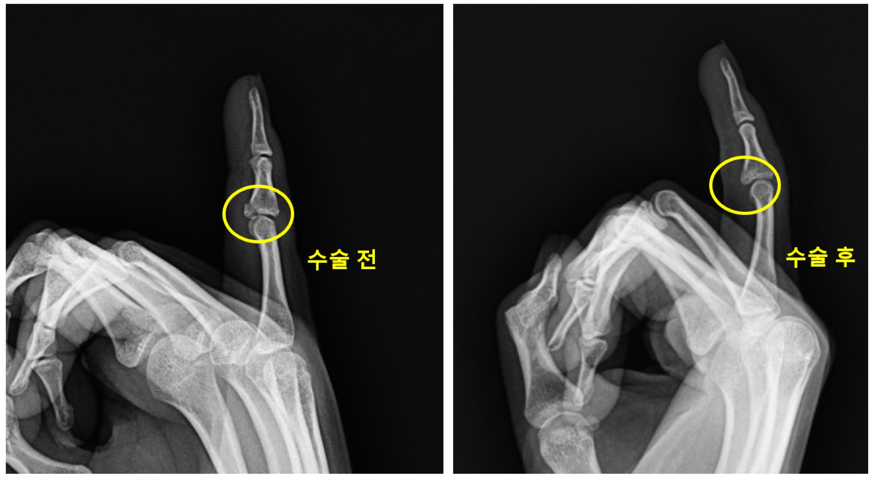 새끼손가락 중위지관절 골절 수술 전후 비교 X-ray 사진