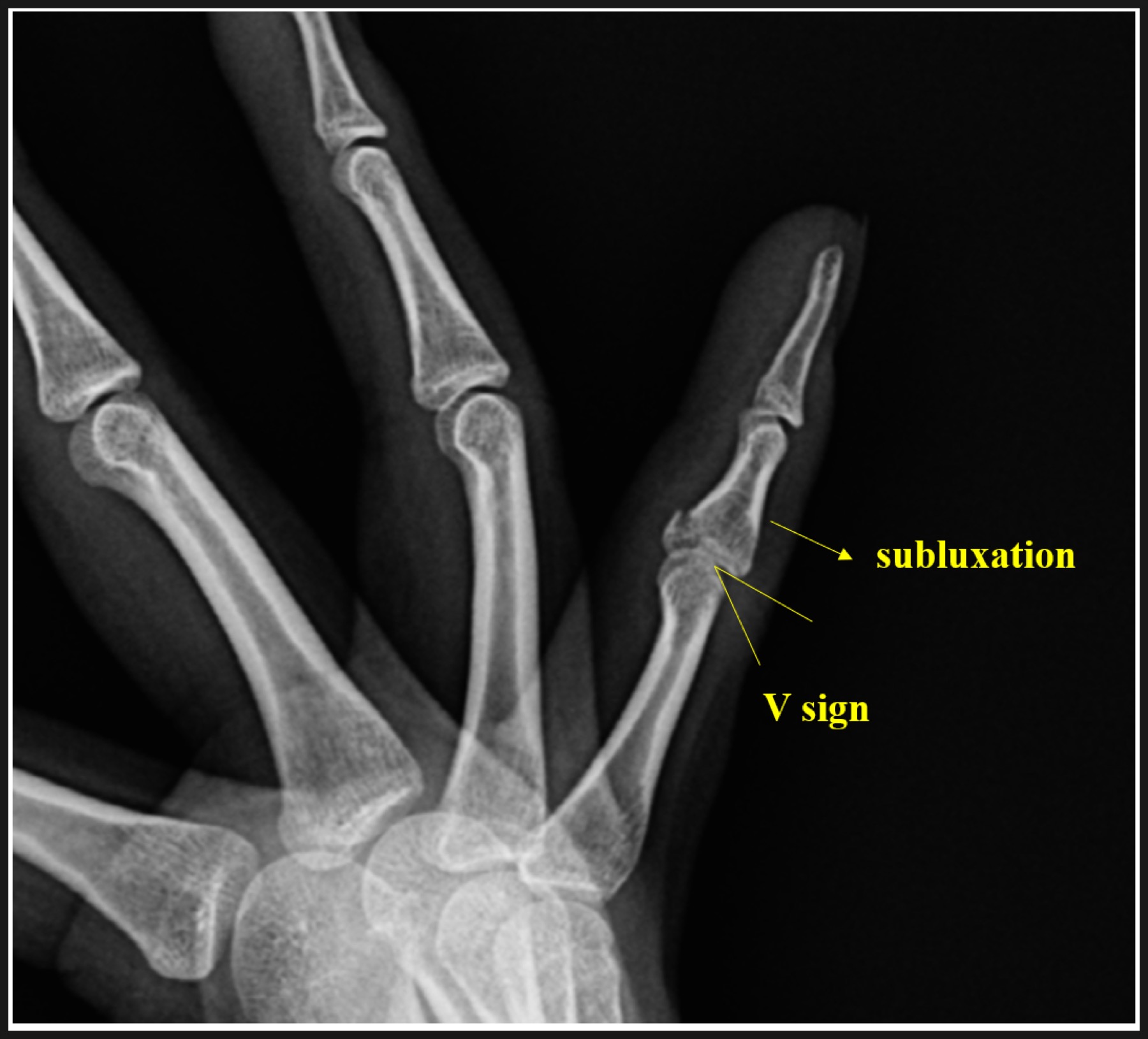 새끼손가락 중위지관절 골절 수술 전 X-ray 사진