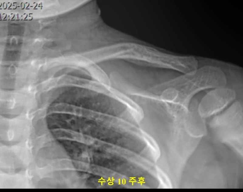 수상 10주차 소아 쇄골 골절 X-ray