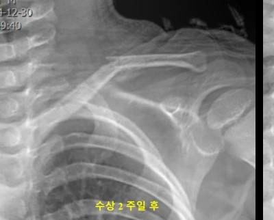 수상 2주차 소아 쇄골 골절 X-ray