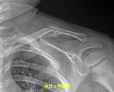 수상 3주차 소아 쇄골 골절 X-ray