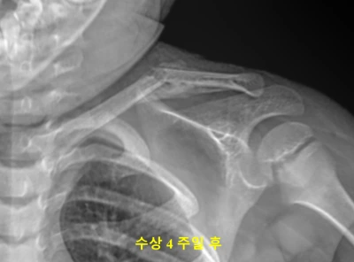 수상 4주차 소아 쇄골 골절 X-ray