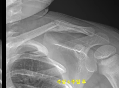 수상 6주차 소아 쇄골 골절 X-ray
