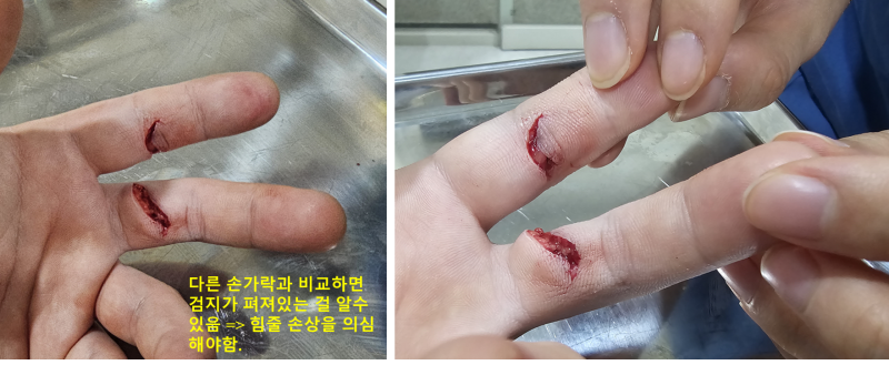 유리 손상으로 검지와 중지에 상처가 생긴 수술 전 사진