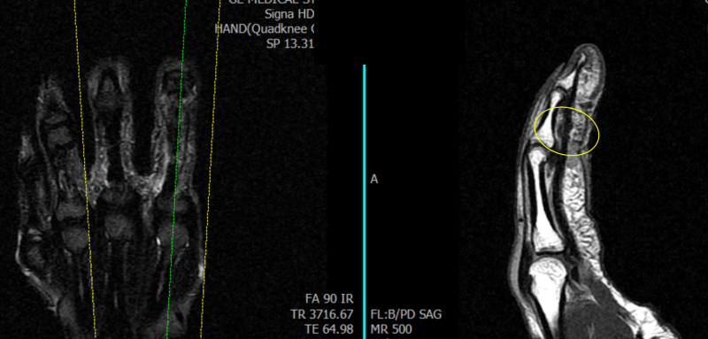 봉합한 검지 굴곡건의 연결 상태를 확인한 수술 후 MRI