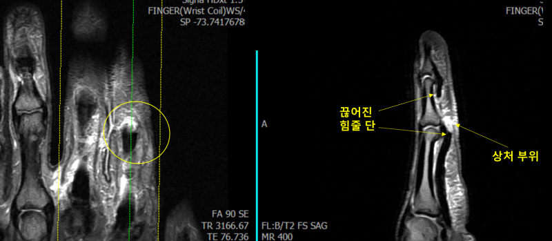 검지 굴곡건 Zone II 완전 파열을 표시한 수술 전 MRI