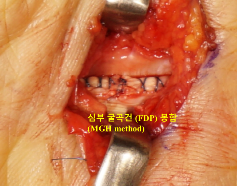 굴곡건 봉합 후 수술 사진