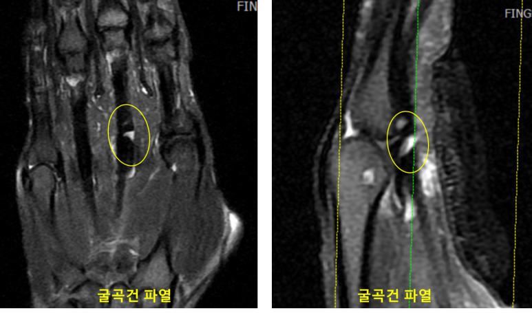 손가락 굴곡건 파열 MRI 이미지