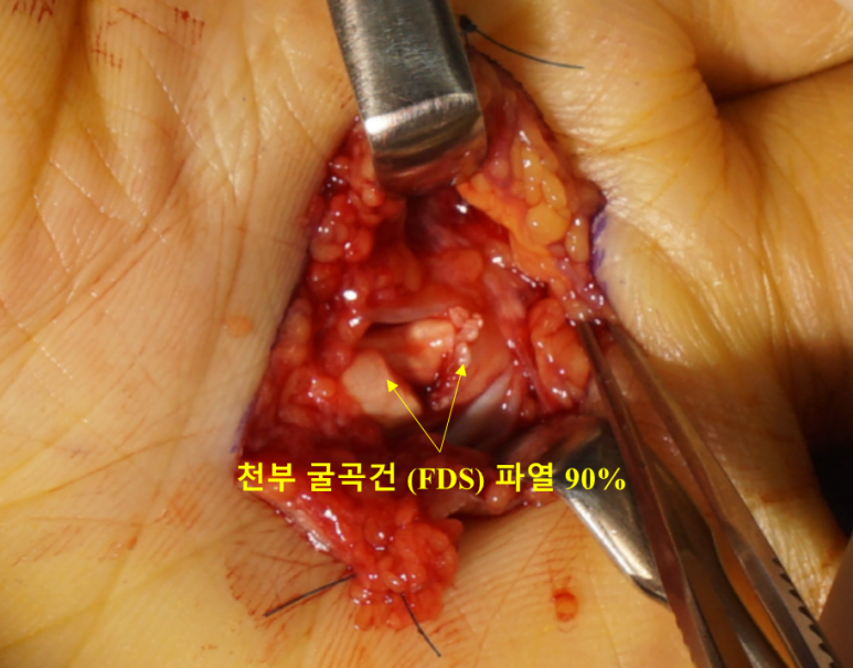 수술 중 굴곡건 파열 확인 사진