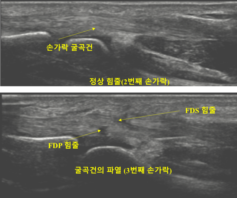 손가락 굴곡건 파열 초음파 검사 이미지