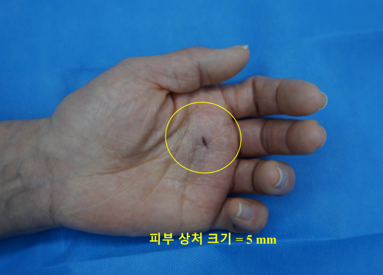 손바닥 5 mm 상처 사진