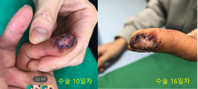 전층 피부이식 수술 후 10일과 16일 경과 사진