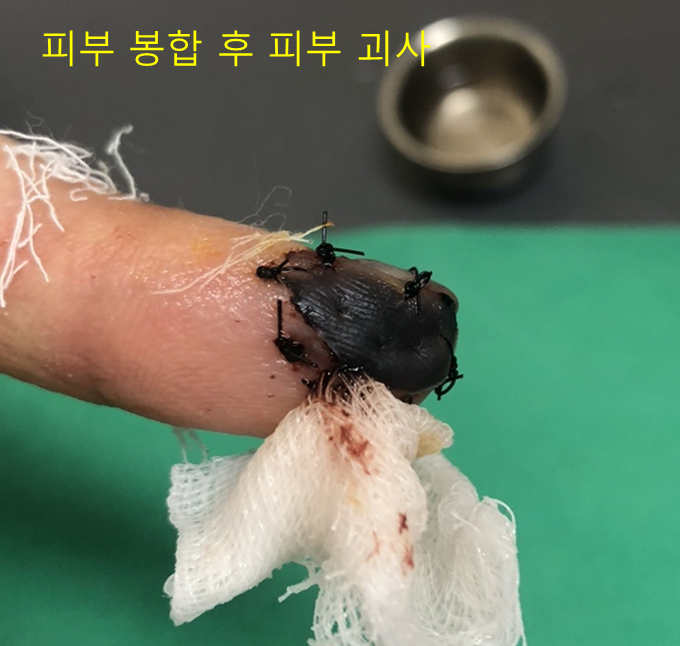 피부 봉합 후 손끝 피부 괴사 사진