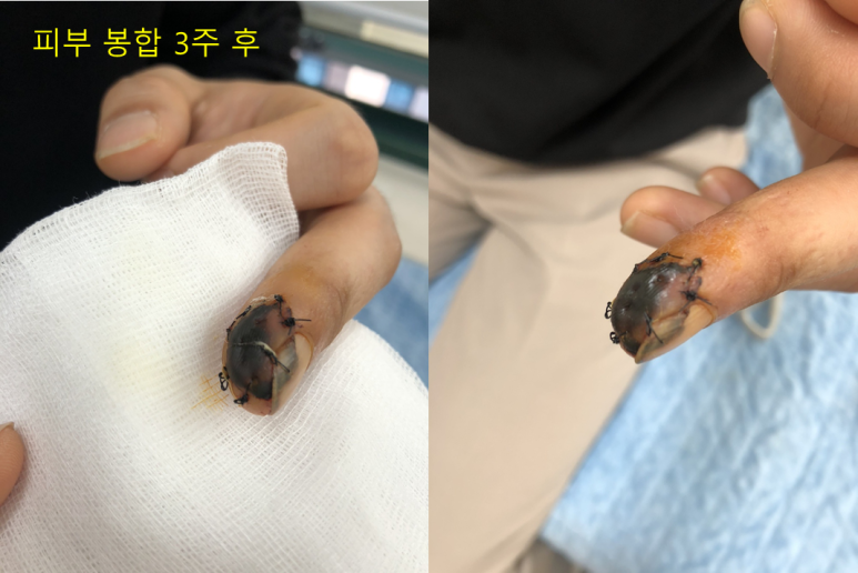 피부 봉합 3주 후 손끝 괴사 경과 사진