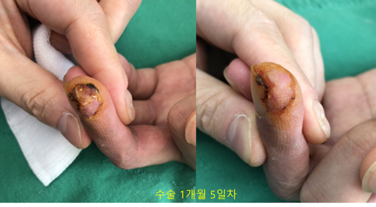 전층 피부이식 수술 후 1개월 5일 경과 사진