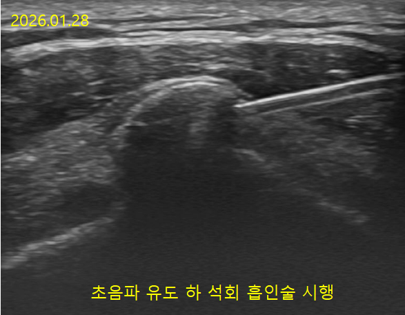 초음파 유도 석회흡인술