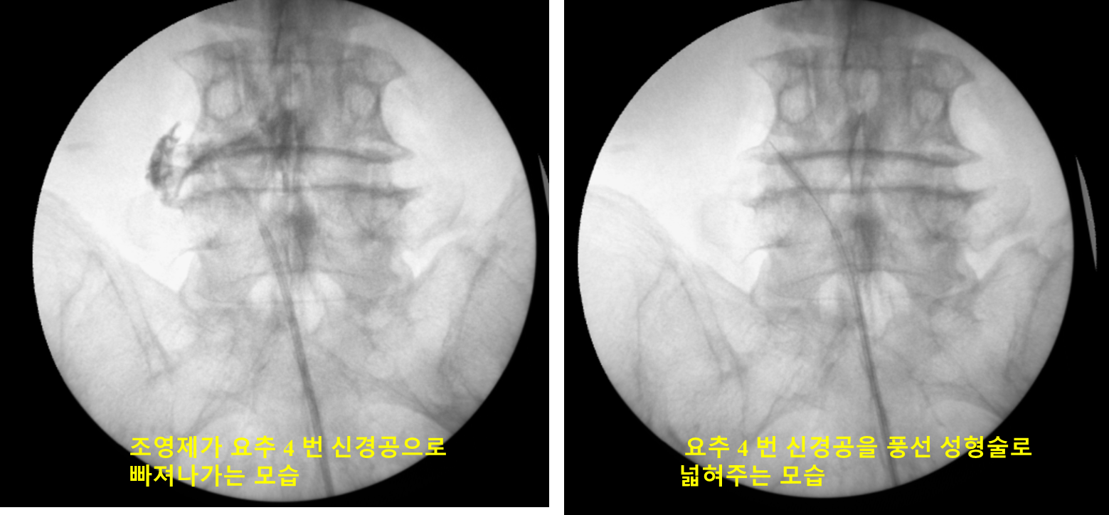 신경공 조영과 풍선 확장