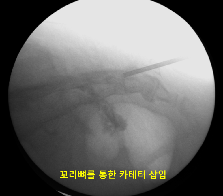 꼬리뼈를 통한 카테터 삽입