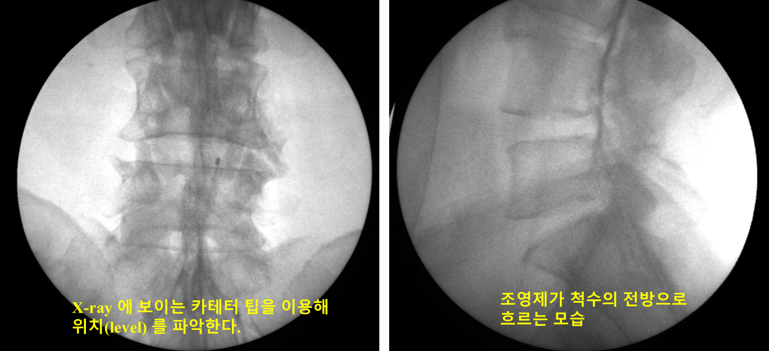 카테터 위치와 조영제 흐름 확인