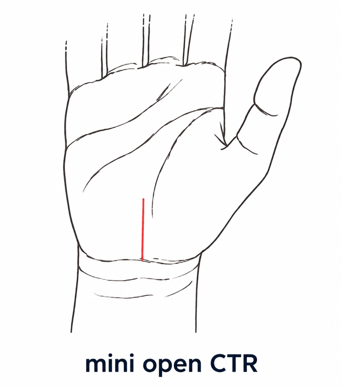 mini open CTR 절개 위치