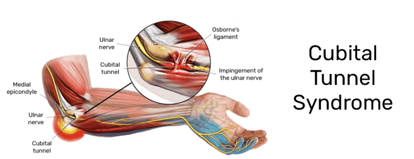 Anatomical illustration showing the ulnar nerve and the site of compression in the cubital tunnel at the inner elbow