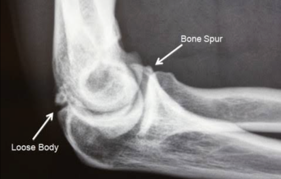 Elbow arthritis X-ray with arrows identifying a bone spur and a loose body inside the joint