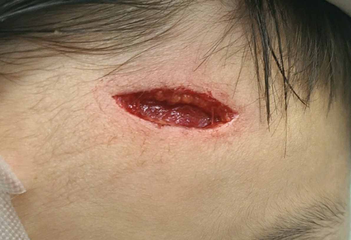 Clinical photo of an open facial laceration near the hairline
