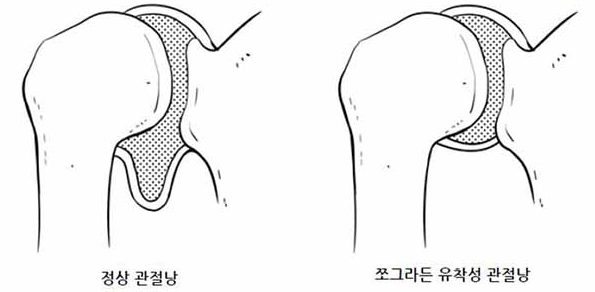 오십견 알아보기
