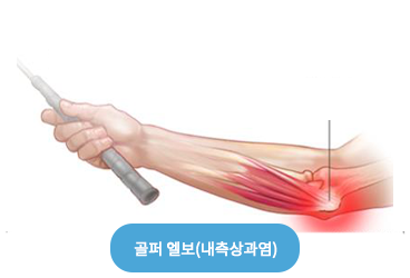 골프엘보 알아보기
