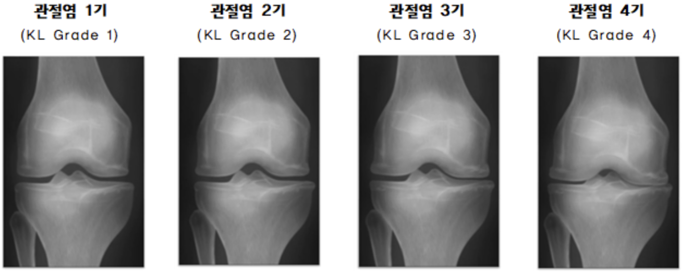 무릎 퇴행성 관절염의 K-L 1기부터 4기까지 관절 간격 변화를 비교한 X-ray 이미지