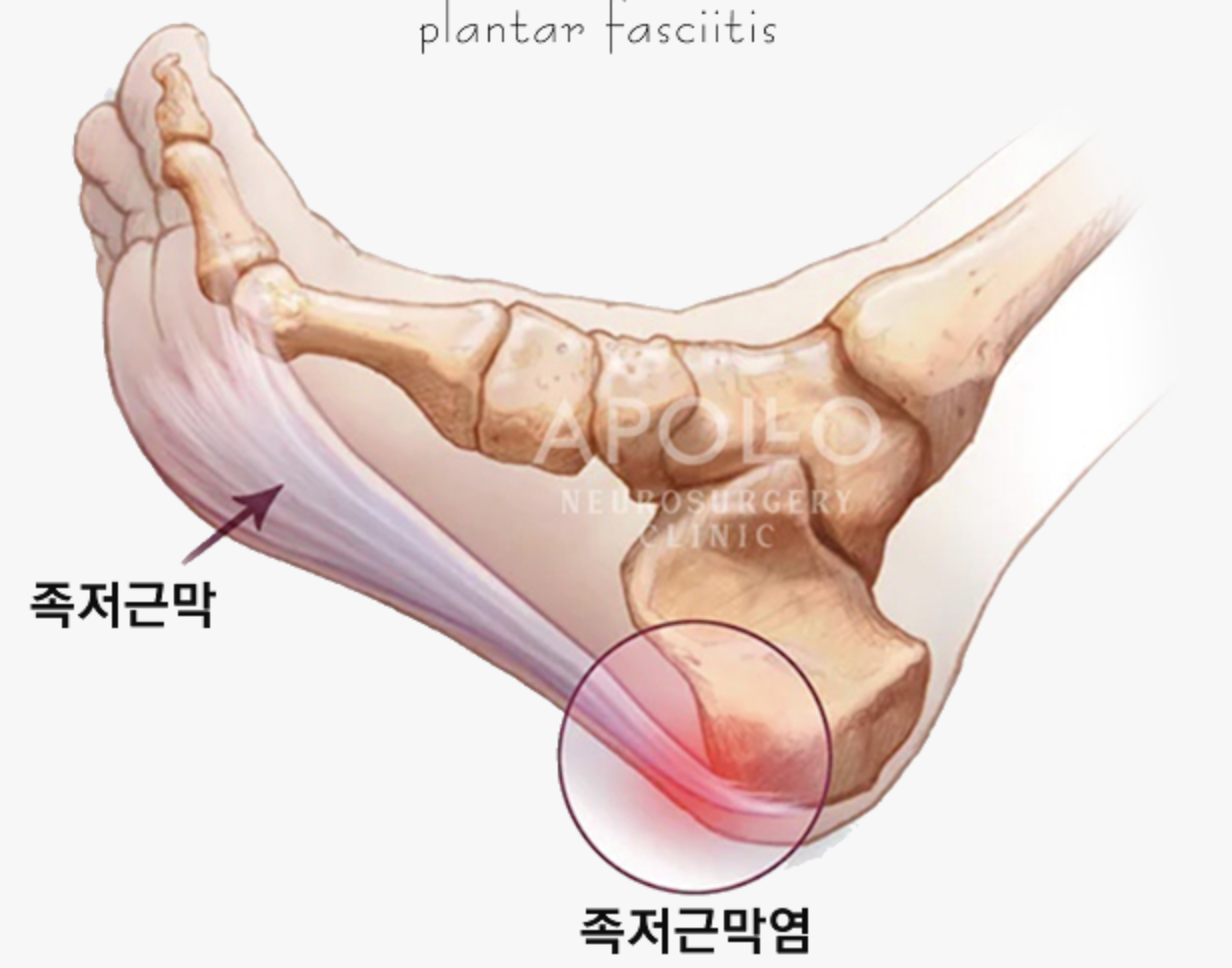 Anatomical illustration identifying the plantar fascia and the inflamed area near the heel