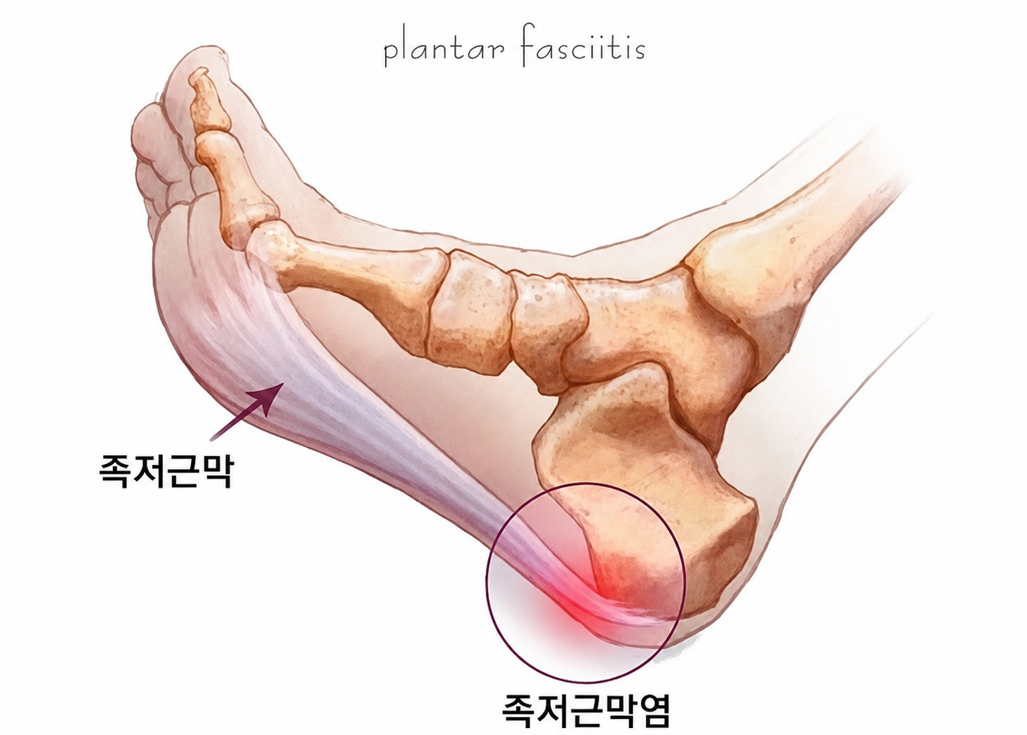 족저근막과 뒤꿈치 통증 부위를 표시한 발 해부 그림