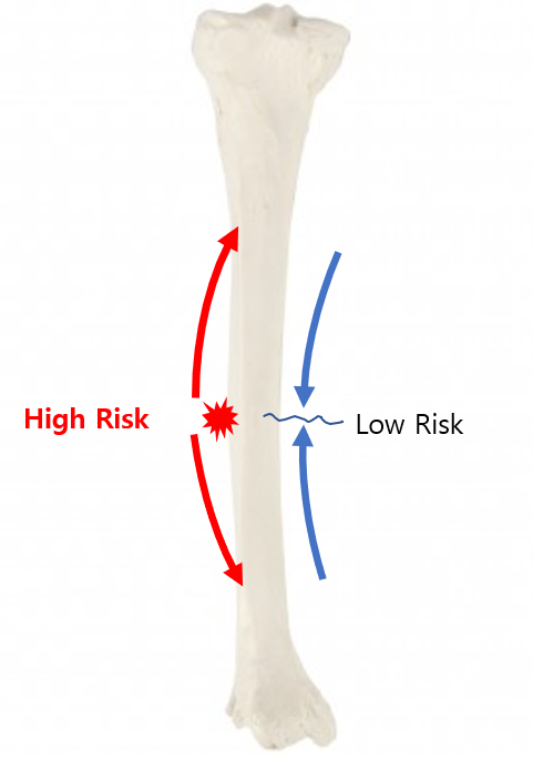 Tibia illustration comparing high-risk and low-risk stress fracture locations