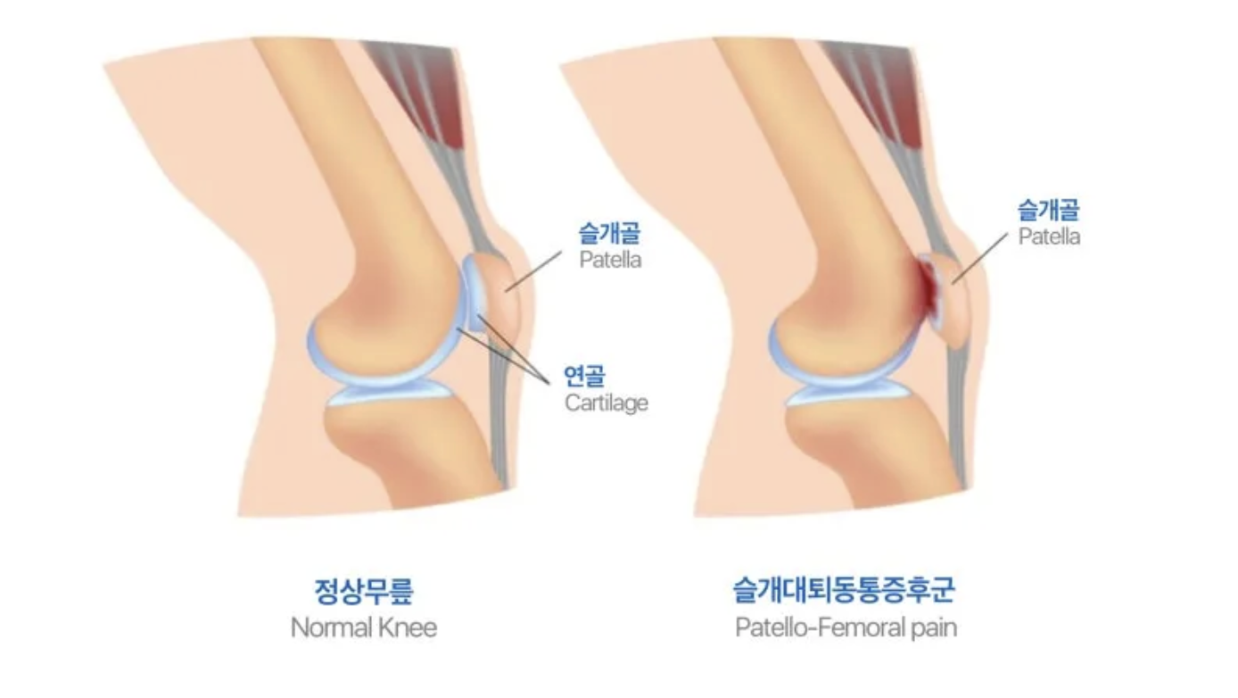 Comparison of a normal knee and patellofemoral pain showing the patella and cartilage