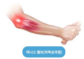 테니스엘보 알아보기