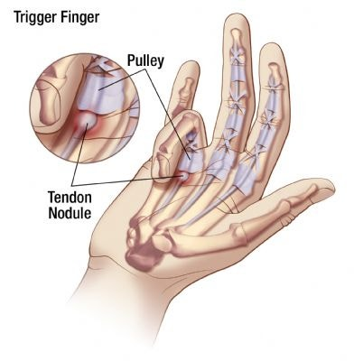 Anatomical illustration labeling the tendon nodule and pulley involved in trigger finger
